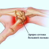 Упражнения при артрозе первого пястно-запястного сустава